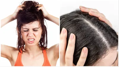 ऑयली स्कैल्प की समस्या से हैं परेशान  तो दूर करने के लिए करें ये उपाय  oily scalp remedies