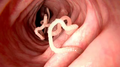 वियतनाम की महिला की स्किन के नीचे मिले परजीवी कीड़े  इनके बारे में जानकारी से हो सकता है बचाव  parasitic worms in human