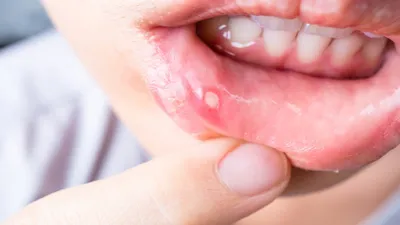 इन घरेलू नुस्खों से करें मुंह के छालों को ठीक  remedies for mouth ulcers