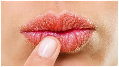 होंठों पर हो गया है सनबर्न  जानें इन्हें ठीक करने के जबरदस्त उपाय  lip sunburn remedy