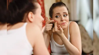 मुंहासों से हैं परेशान तो करें घरेलू उपाय  home remedies for acne