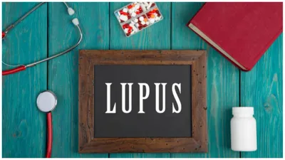 जानिए कितना खतरनाक है ल्यूपस रोग  क्या हैं इसके लक्षण  symptoms of lupus