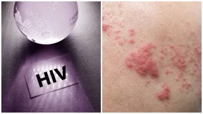 hiv और aids होने पर हो सकती हैं ये स्किन प्रॉबलम्स  aids rashes and skin conditions