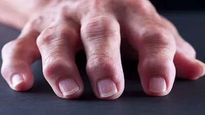 आ जाती है हाथ पैर की उंगलियां में सूजन तो आजमाएं ये असरदार घरेलू नुस्‍खे  swelling remedy