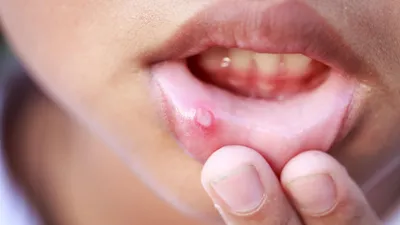 बार बार होने वाले मुंह के छालों के लिए उपयोगी हैं ये उपाय  remedies for mouth sore