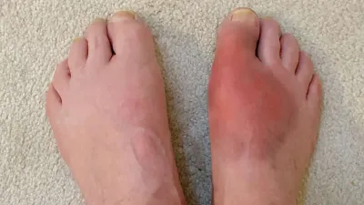 पैरों के आसपास दिखने वाले ये संकेत से समझ जाएं बढ़ चुका है यूरिक एसिड  uric acid symptoms on feet