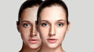 उम्र ही नहीं इन कारणों से भी हो सकती है नाक पर झाइयां  इन आसान घरेलू चीजों से मिलेगा छुटकारा  freckles on the nose